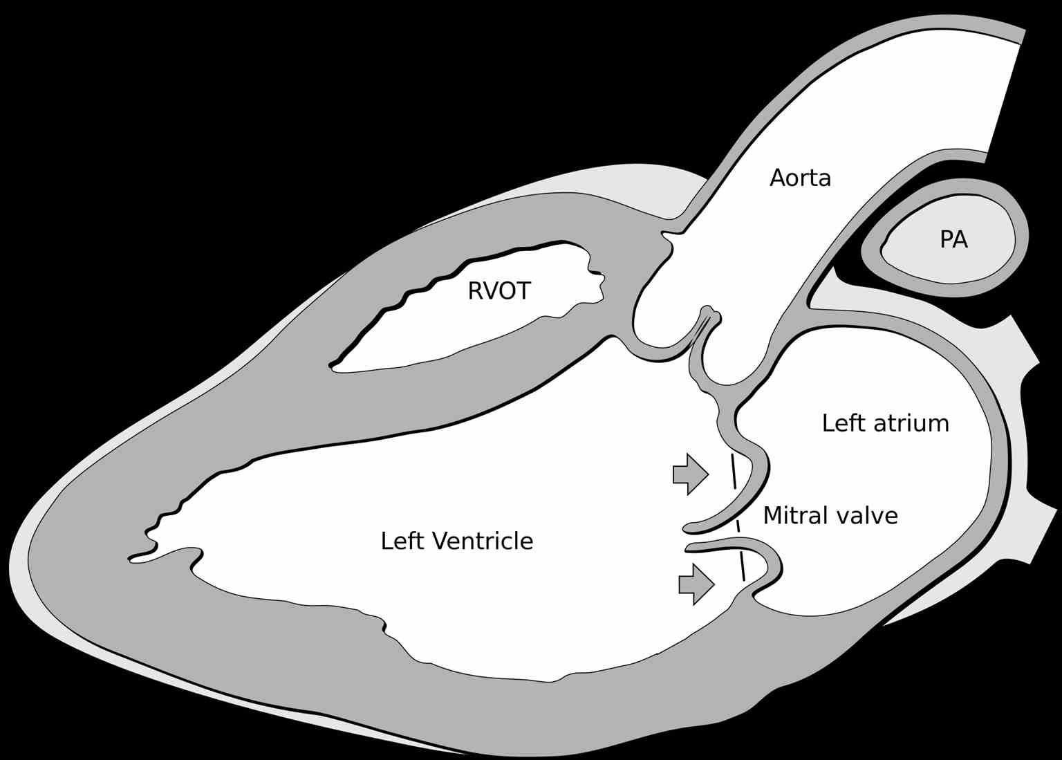 Mitral Valve Prolapse