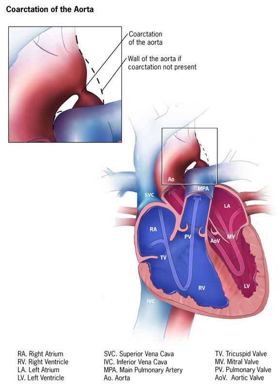 Coarctation of the Aorta