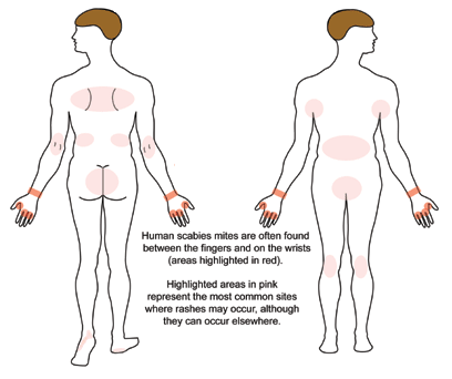 Commonly involved sites of rashes of scabies.