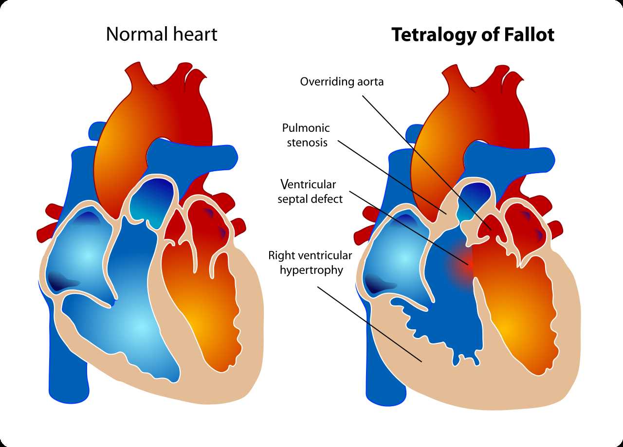 A diagram showing a healthy heart and one suffering from the tetralogy of Fallot, which constitutes four different malformations