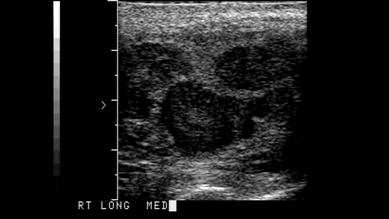 Ultrasound of Seminoma of the Testicle