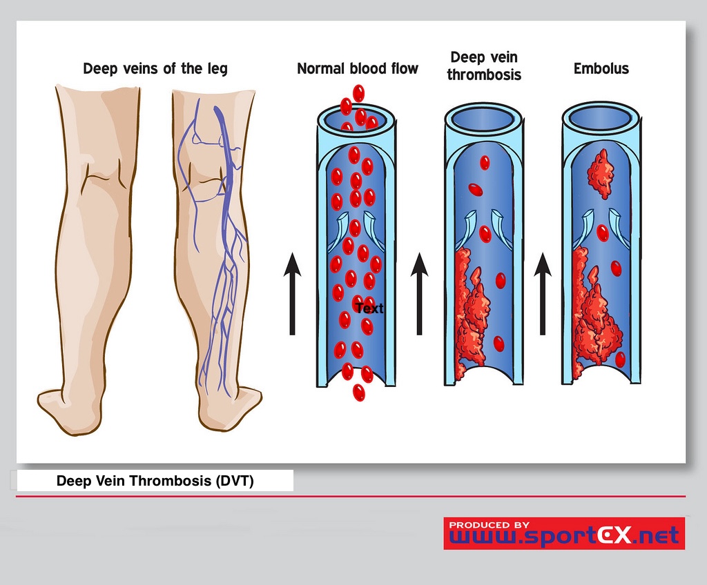 Deep Vein Thrombosis (DVT)