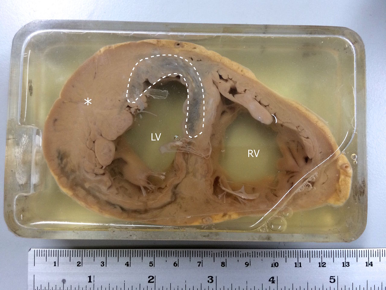 Specimen showing myocardial infarction in the left ventricle and the interventricular septum