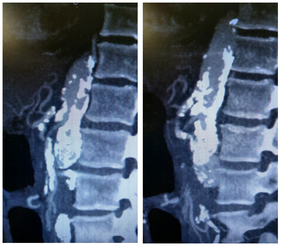 Sagittal view of CT angiogram showing severe atherosclerotic disease of the SMA and celiac artery.