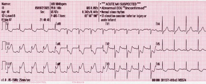 An ECG showing pardee waves indicating acute myocardial infarction in the inferior leads II, III and aVF with reciprocal changes in the anterolateral leads