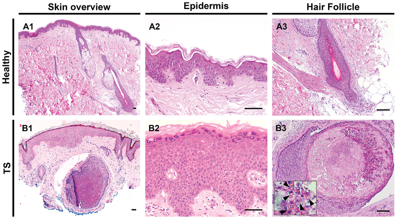 Histology, Trichodysplasia spinulosa, Trichodysplasia spinulosa polyomavirus, Healthy control on top, TS skin on the bottom, 