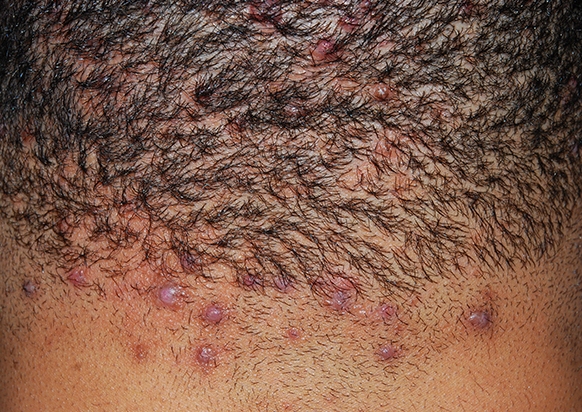 Acne Keloidalis Nuchae, Follicular-based papules, Pustules