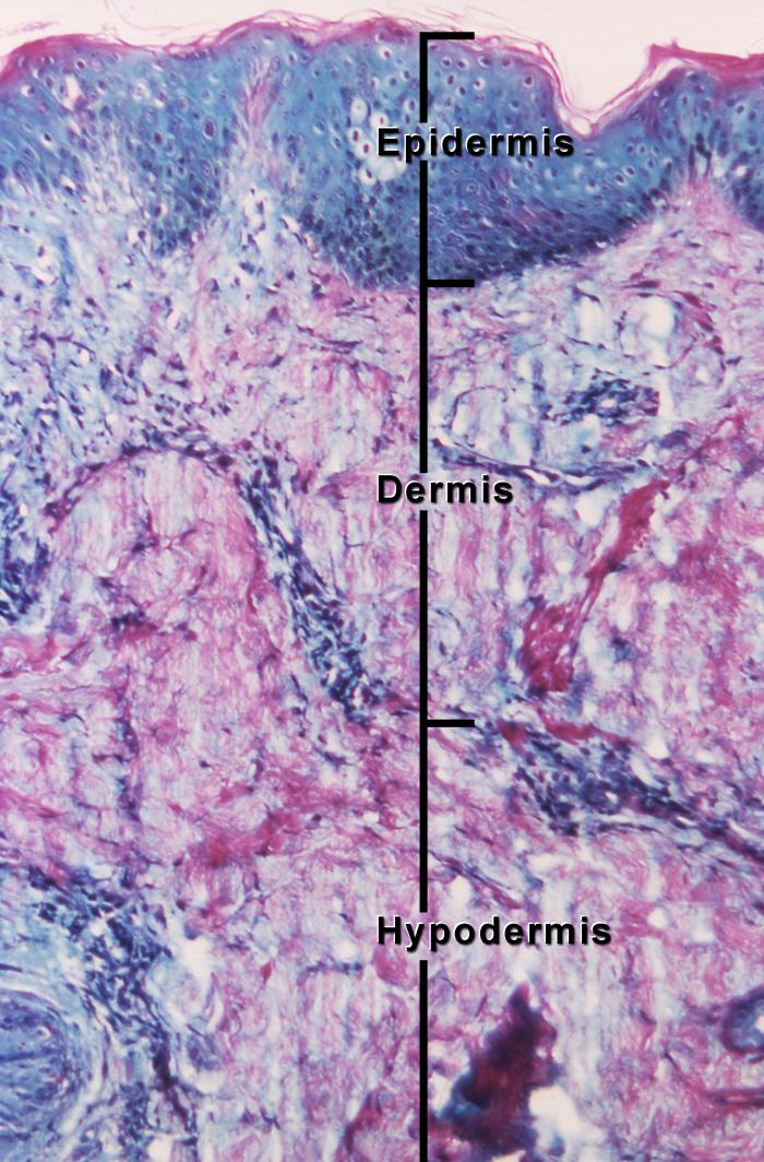 Photomicrograph, Human tissue, Epidermis, Dermis, Hypodermis, Melanocyte, Melanoma, Cancer, Squamous Cells