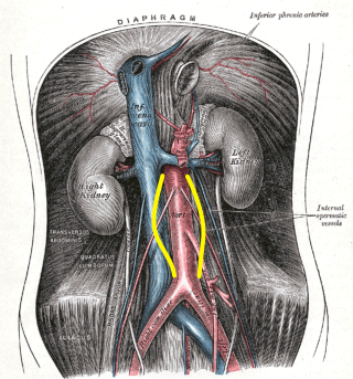 Abdominal Aortic Aneurysm, Distention shown by yellow markings, Aorta, Inferior Vena Cava, Aneurysms