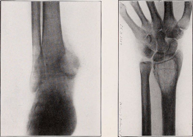 Tuberculosis Benign Bone Cyst, Radius, Ulnar, Central giant-of internal malleolus of tibia, cell tumor of lower end of radius