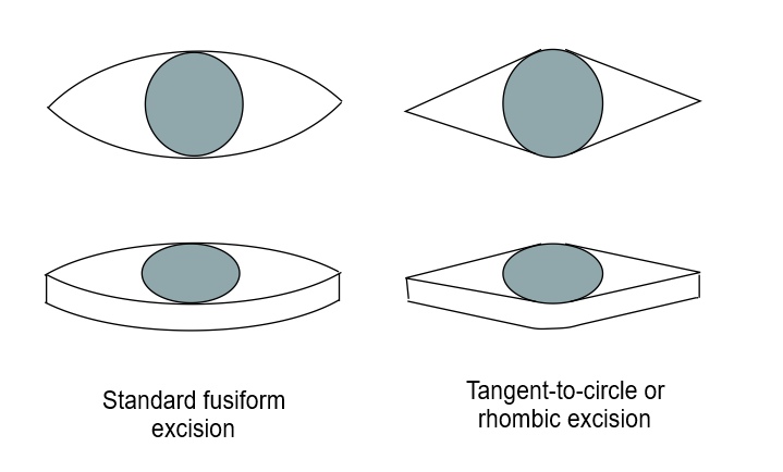 Fusiform Incision and Excision