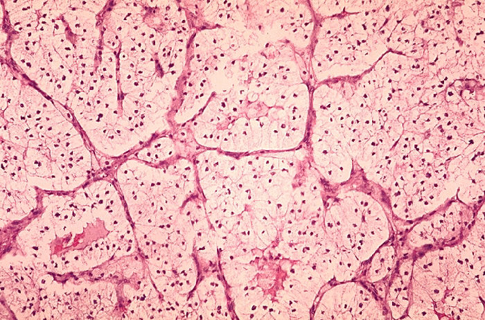 Histology, Pathology, Histopathology of renal cell adenocarcinoma kidney, Cancer, Neoplasms, Kidney Diseases