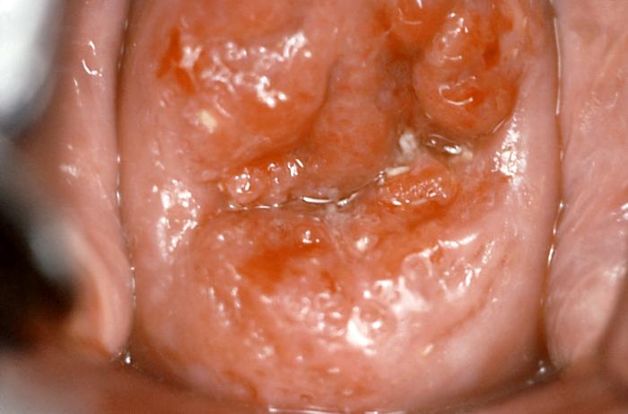 Colposcopic View of the Cervix in a Patient with Invasive Cervical Cancer