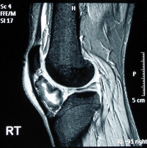 Magnetic resonance imaging of the knee demonstrating ossification in the peritendinous tissues in a patient with osteochondro