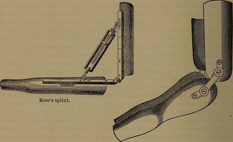 Rose's Splint on the left, Splints, Welch's Splints on the Right, amputation, Fractures, elbow joint