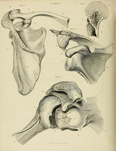 Treatise on dislocation and on fracture of the joints, dislocations, fractures, bone, joints, Figure 1 shows dislocation of t