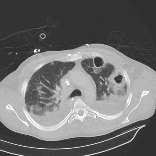 Computed Tomography Scan, CT Scan, showing bilateral pneumonia, abscesses, effusions, cavers, adult male