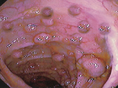 FPC, Cysts, Lesion, Familial Polyposis Coli, Cancer of the Large Intestine