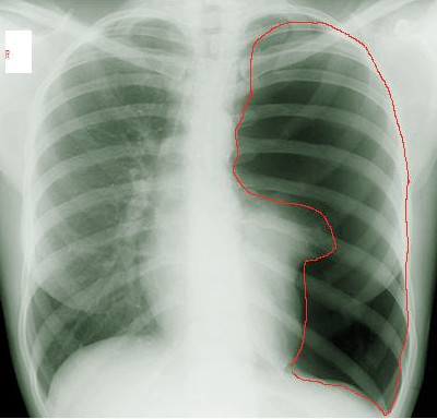 Pneumothorax, X-ray