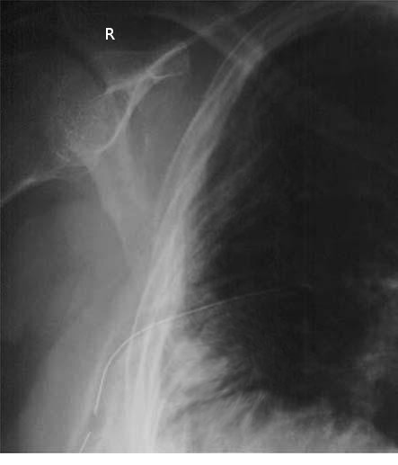 Chest tube, X-ray