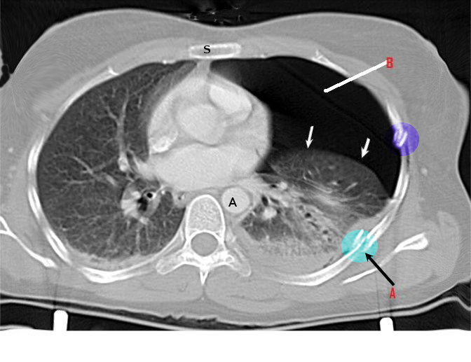 Ct rib fracture, CT Scan, pneumothorax, collapsed lung