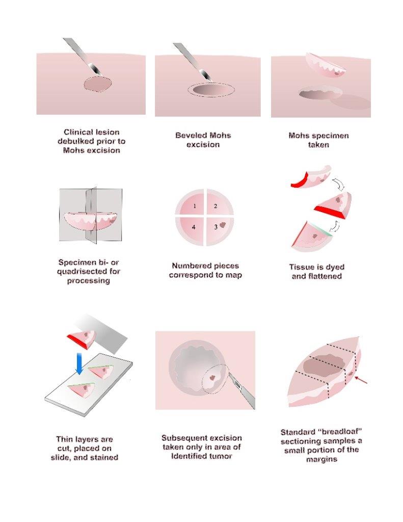 Mohs Surgery Diagram