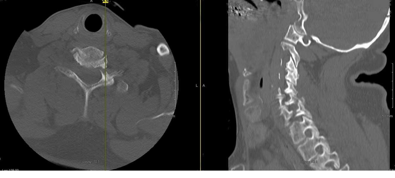 CT scan of C67 cervical spine fracture