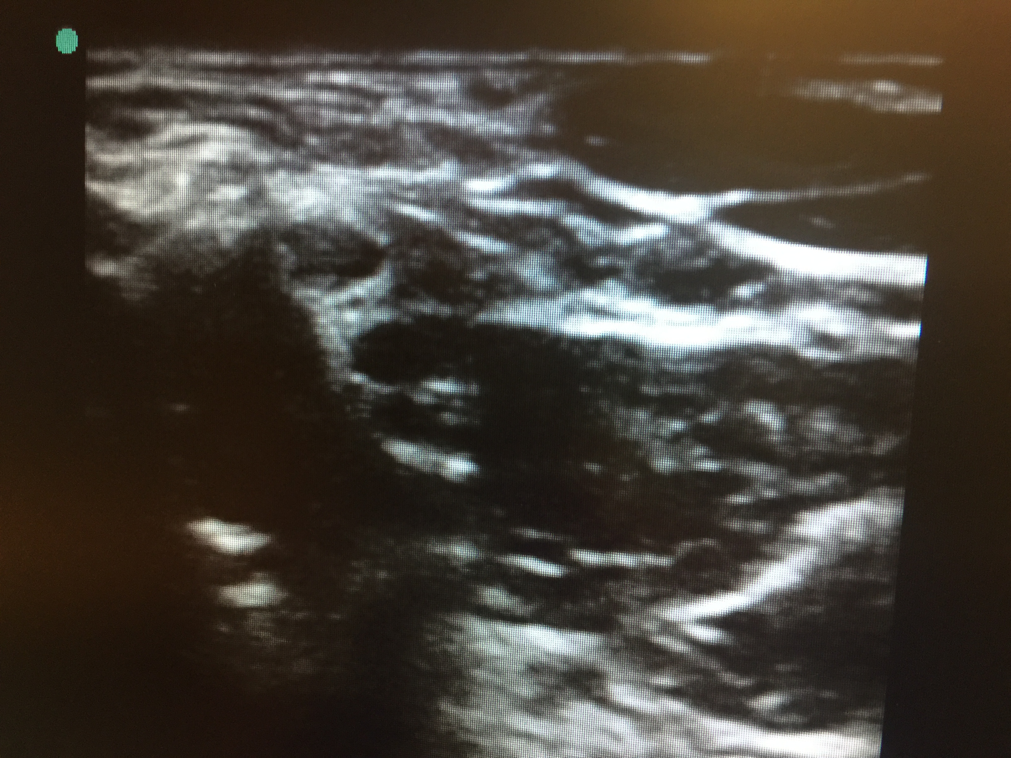 Interscalene nerve "stoplight" sign