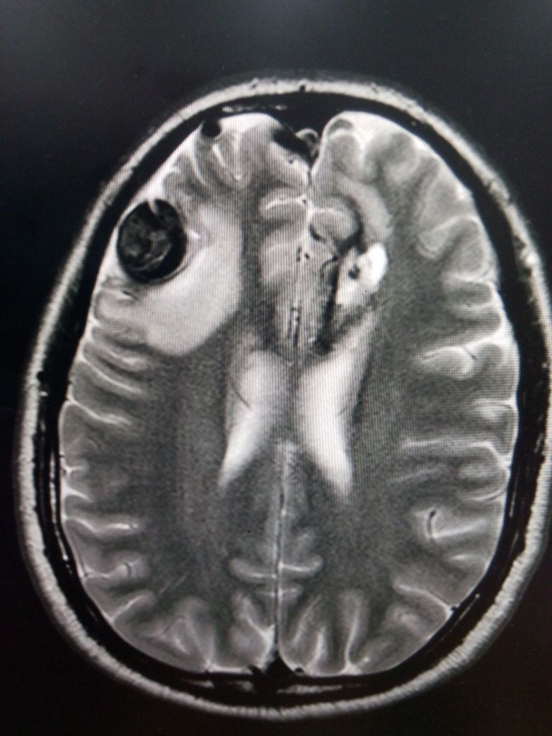 Another patient 30 years lf presented with altered consciousness MRI brain reveals superficially located AVM with aneurysm fo