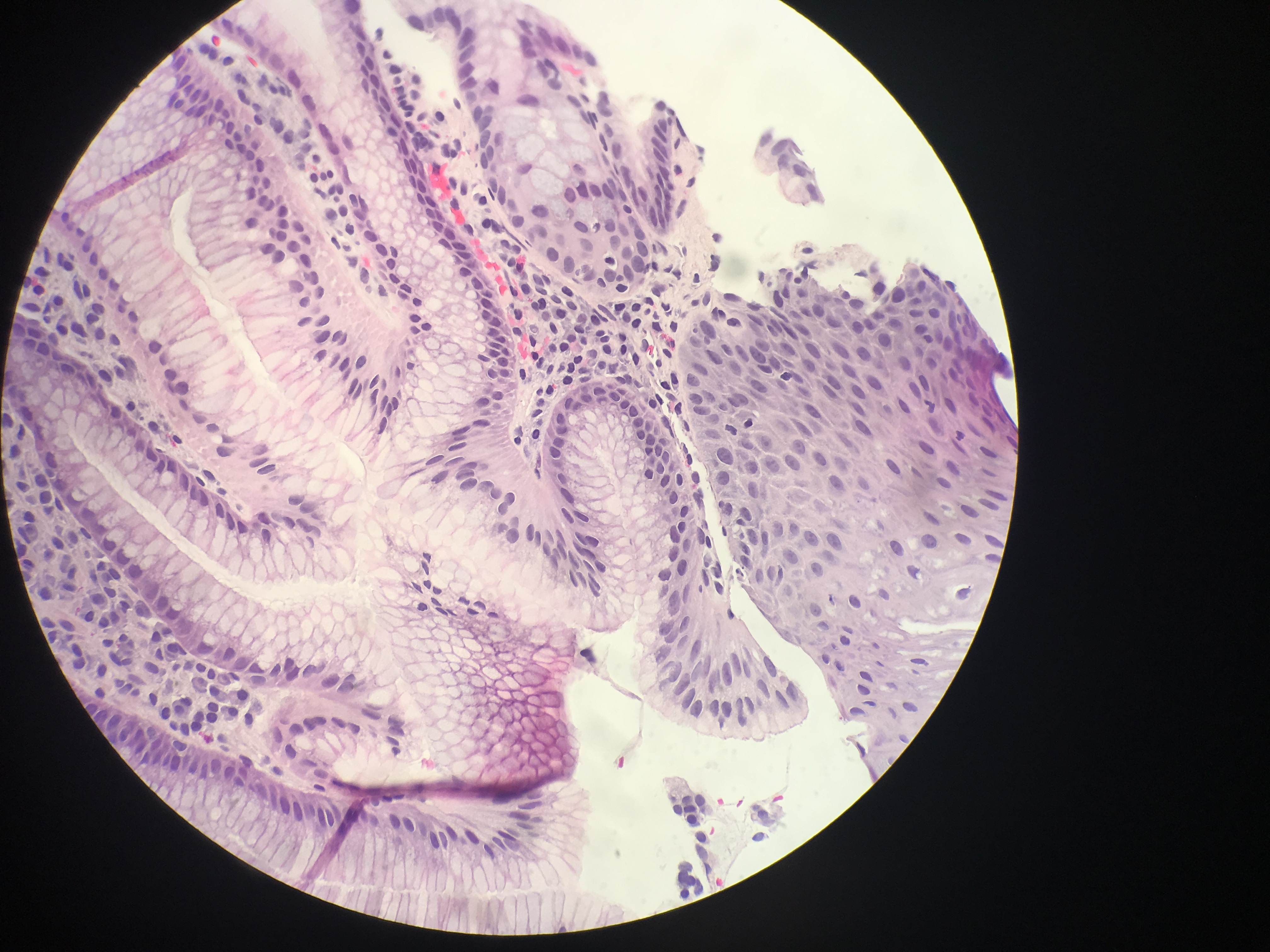 Squamocolumnar junction with focal goblet cells, consistent with Barrett esophagus