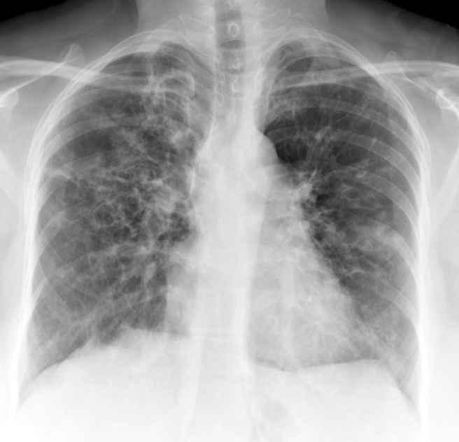 X-ray, COPD, Chronic Obstructive Pulmonary Disease, ABPA, Allergic bronchopulmonary aspergillosis, Poster Anterior,