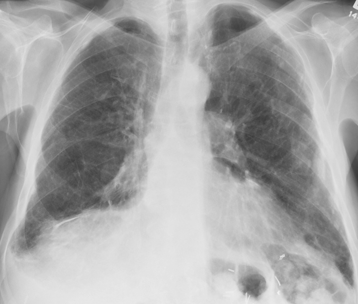 X-ray, Lungs, Asbestos, Anterior View