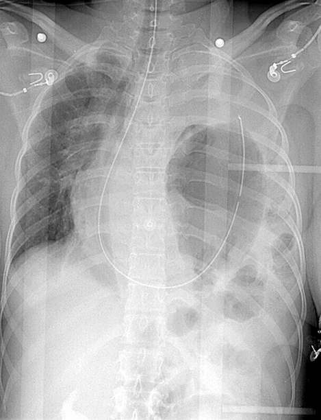 <p>X-Ray, Blunt Chest Trauma