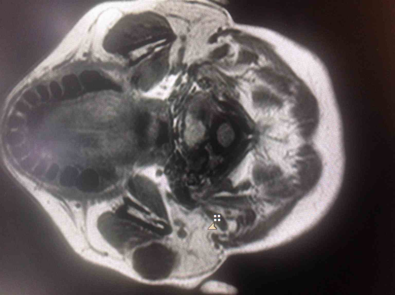 The t1w  axial sequence of face reveals a lobulated hypointense well-defined mass lesion in the right parotid gland of 35-year-old male