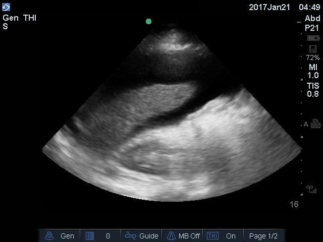 Abdominal ascites