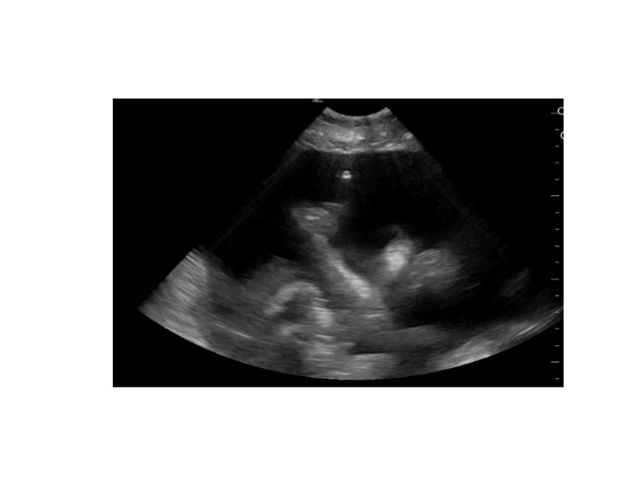 Paracentesis, bowel, ascites.