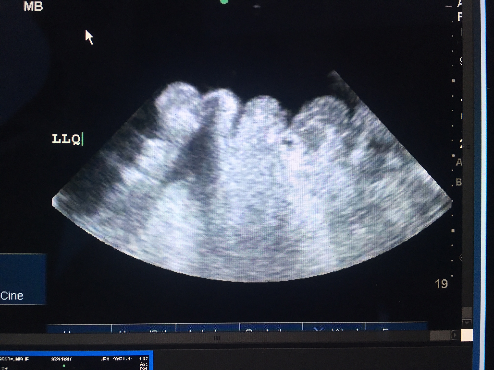 Pocket of ascites ideal for paracentesis