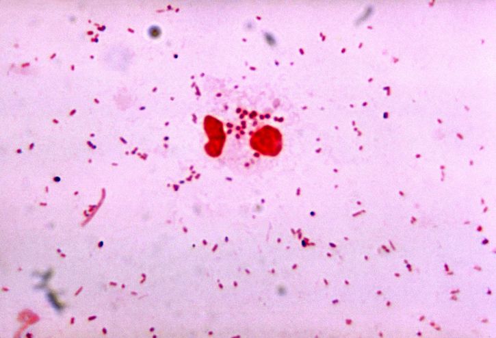 Gram Stain, dipplococcus, Gonorrhea,