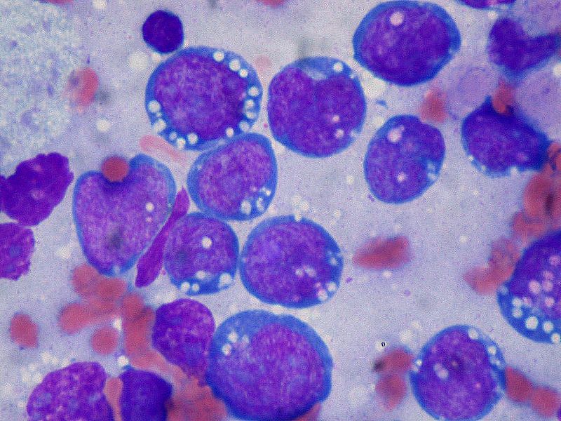 Burkitt Lymphoma, Lymphoblasts