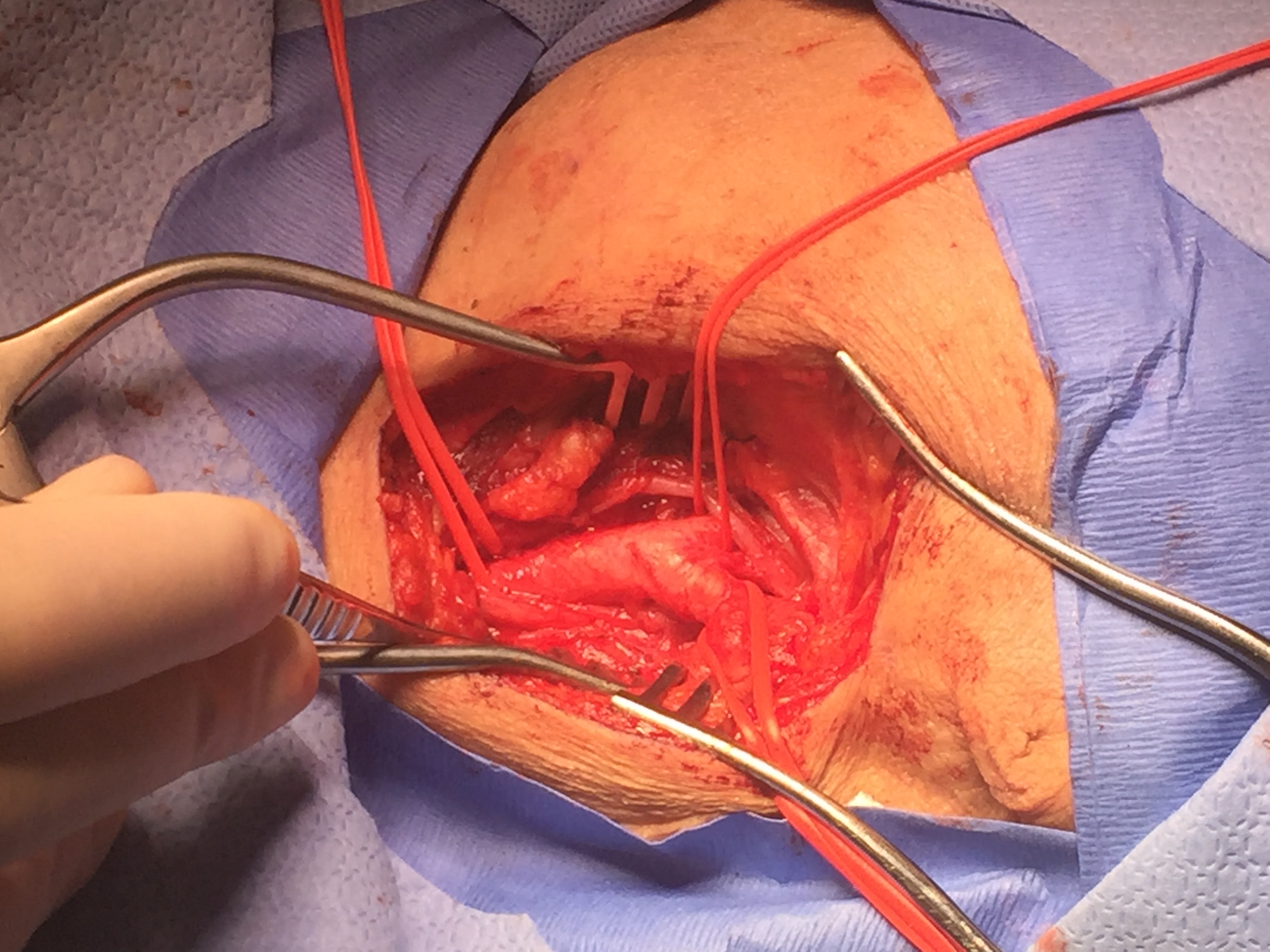 Exposure and Isolation of External and Internal Carotid Artery