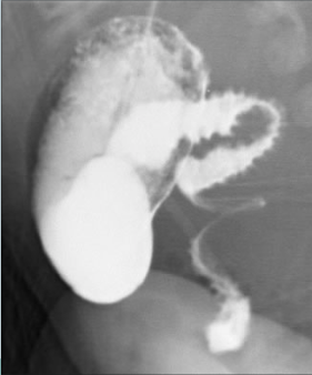 Abnormal C-loop & corkscrew appearance of jejunum