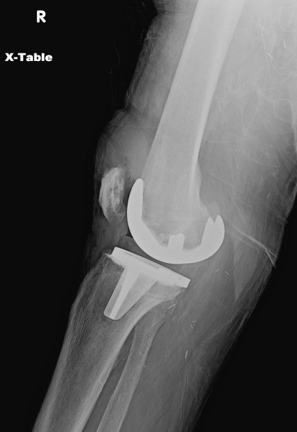 Plain radiograph of the right knee in a 78 year old man with prosthetic joint infection 10 years after initial surgery