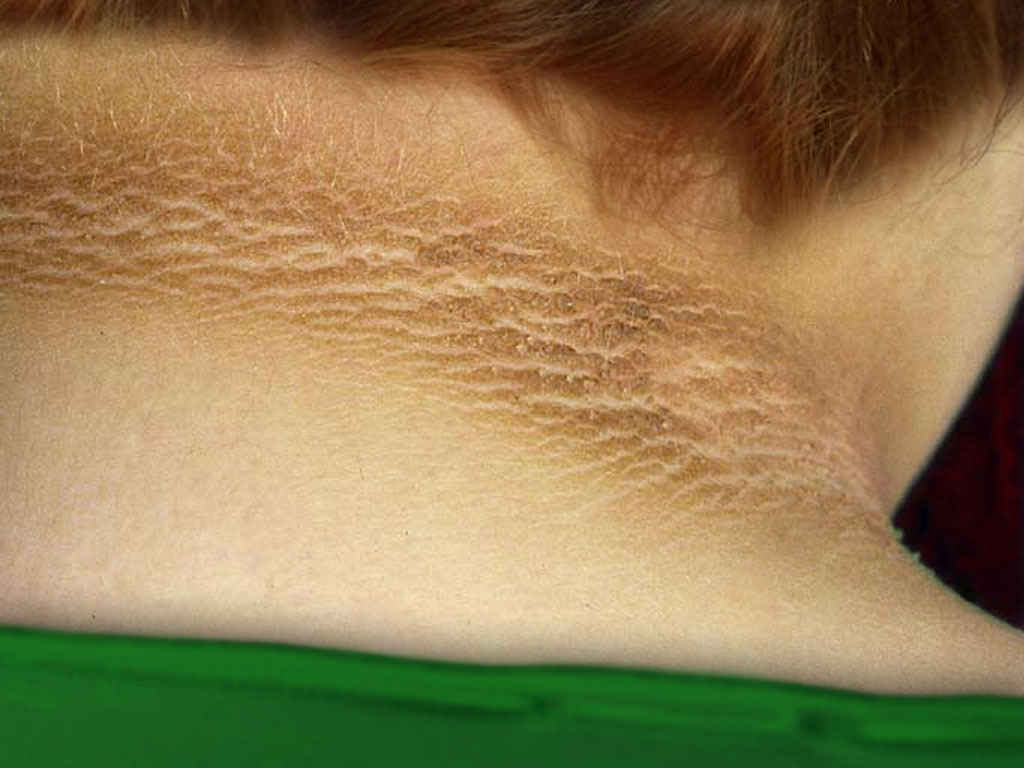 Acanthosis Nigricans