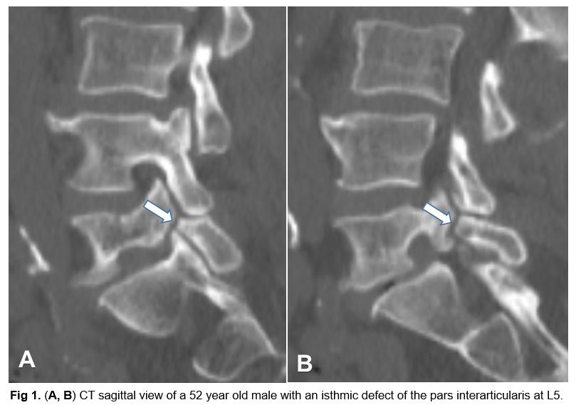 Isthmic Spondylolisthesis