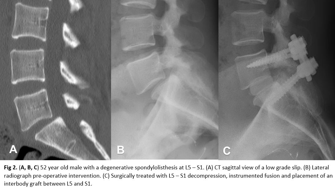 Isthmic Spondylolisthesis intervention