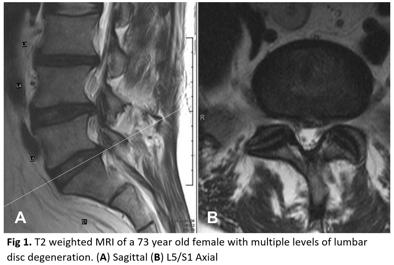 T2 weighted MRI of a 73 year old female with multiple levels of lumbar disc degeneration. (A) Sagittal (B) L5/S1 Axial