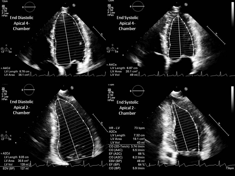 Biplane Simpson Method using the end diastolic and end systolic apical 4- and 2- chamber views for estimation of LV volume an