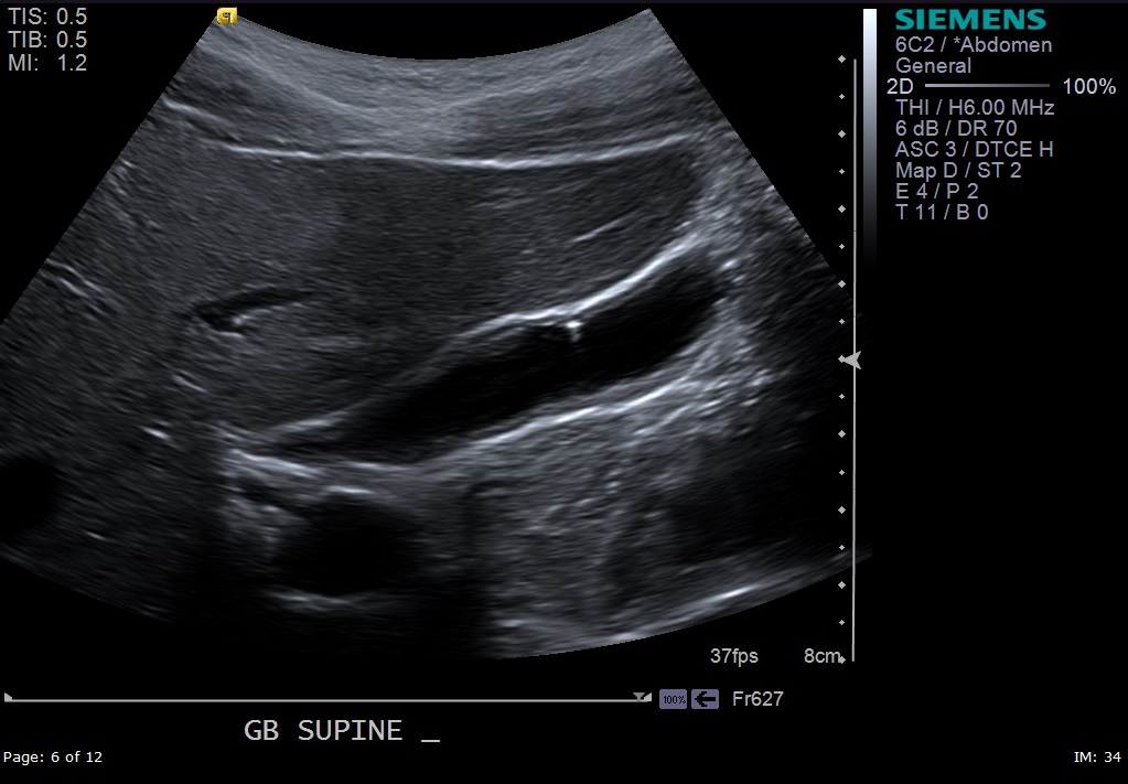 <p>Adenomyomatosis