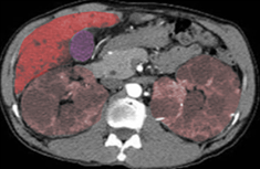 AutosomalPolycystickidney