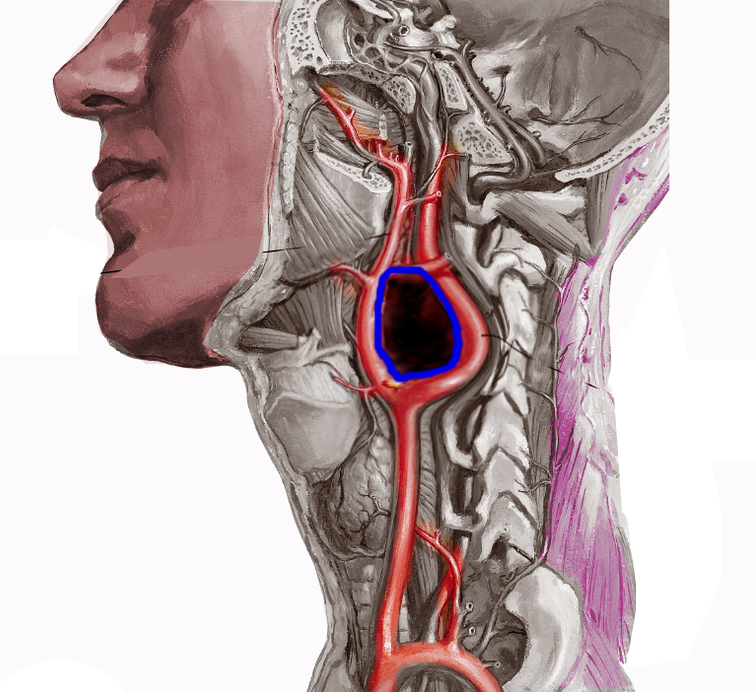 <p>Carotid Artery Tumor